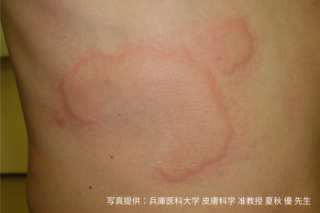 蕁麻疹は伝染性ですか？