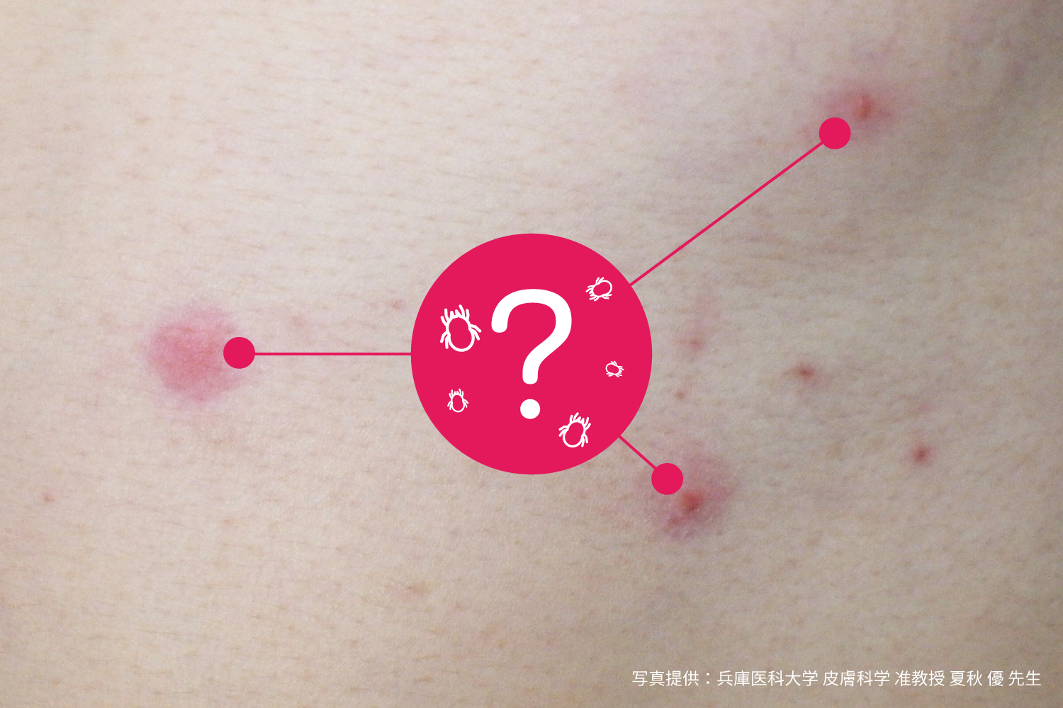 滲出性湿疹とは何ですか？