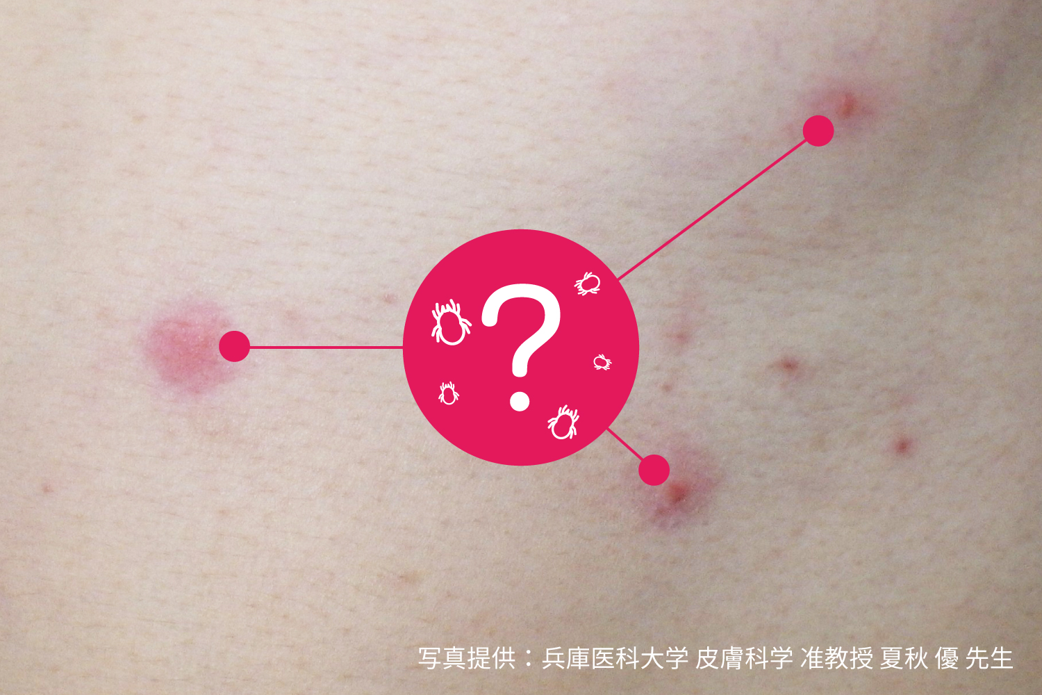 ピーナッツバターは胃酸逆流を引き起こしますか?