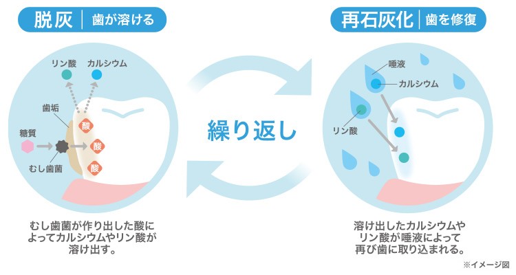 歯 の ひび 再 石灰 化